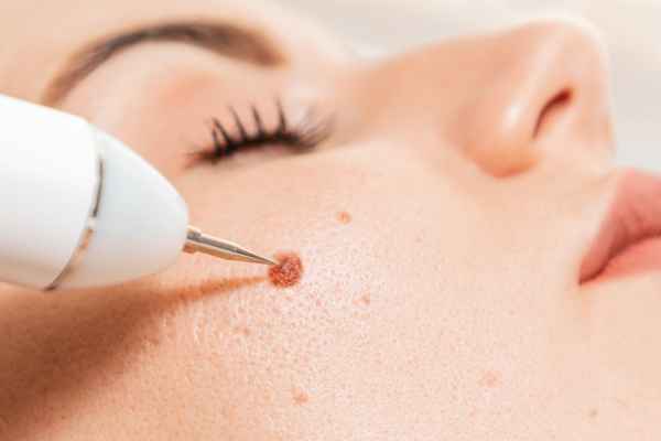 CryoPen: 5 Skin Concerns It May Be Used to Treat 3 What actually happens during a CryoPen treatment Oxted?
