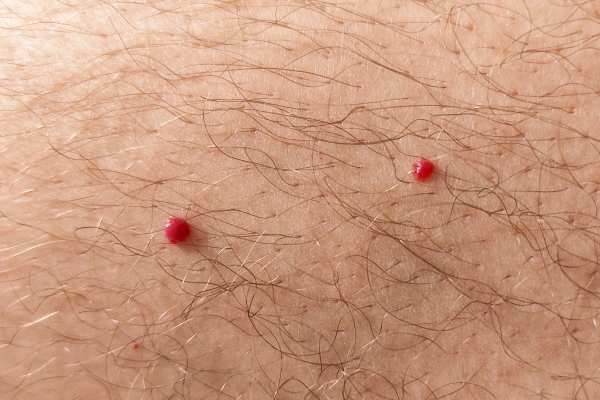 CryoPen: 5 Skin Concerns It May Be Used to Treat 2 cherry angioma removal Oxted