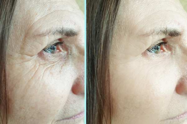 Why Do People Choose HIFU for a Non-Surgical Facelift? 4 How long can HIFU results last Oxted?
