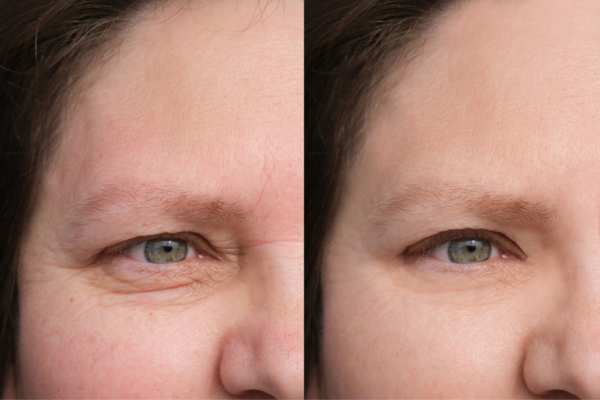 HIFU vs Botulinum Toxin: Understanding the Differences 4 How long do HIFU results last Oxted?