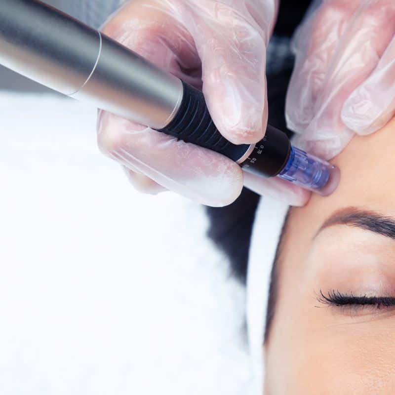 Morpheus8 treatment Oxted from Lipo Sculpt - Book in today!