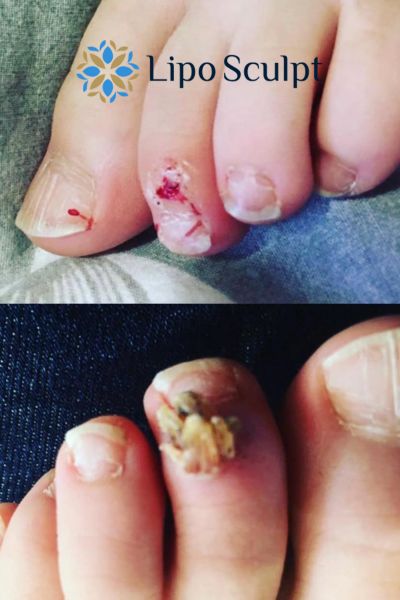Wart removal customer results from Lipo Sculpt Oxted
